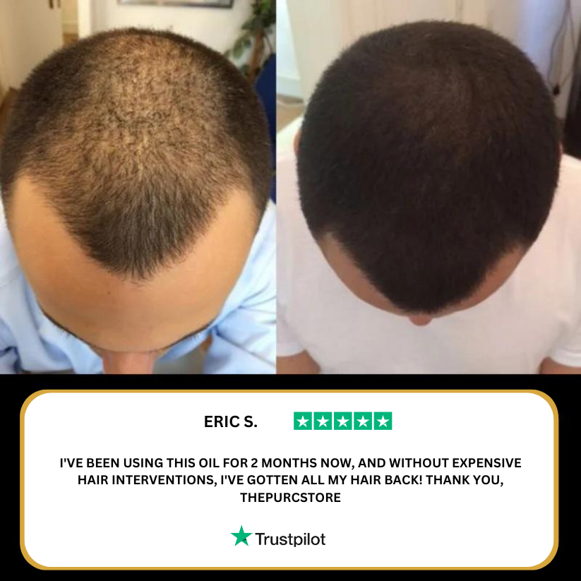 The (VIRAL) Purc™ Natural Hair Growth Oil